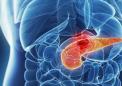 Mayo Clinic和TGen ID可能是最致命形式的胰腺癌的靶标