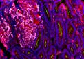 研究人员发现干细胞调节生长因子R-spondin在肠癌中具有令人惊讶的效果