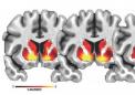 NIH资助的研究将青春期大脑差异与腰围增加联系起来