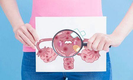 科学家研究了有关子宫内膜异位症对妊娠和分娩的影响