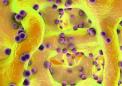 突破性研究确定了慢性非细菌性骨髓炎的关键特征