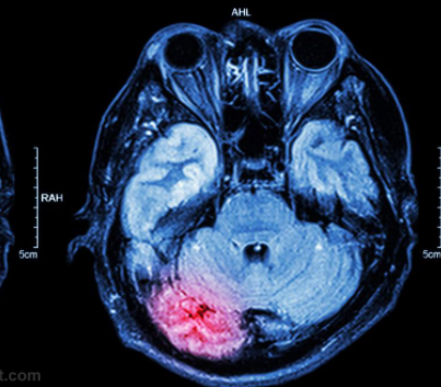 一项新研究发现外伤性脑损伤也可引起肠道损伤
