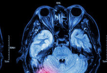 一项新研究发现外伤性脑损伤也可引起肠道损伤