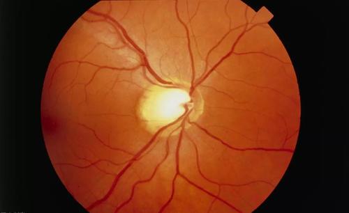 新的青光眼检查可以使数百万人免于失明