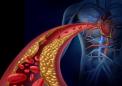 研究表明胆固醇与心脏病之间没有联系