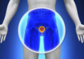 新的iClusters确定了前列腺癌的五种亚型