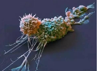 专家们已经确定了使乳腺癌细胞扩散的触发器