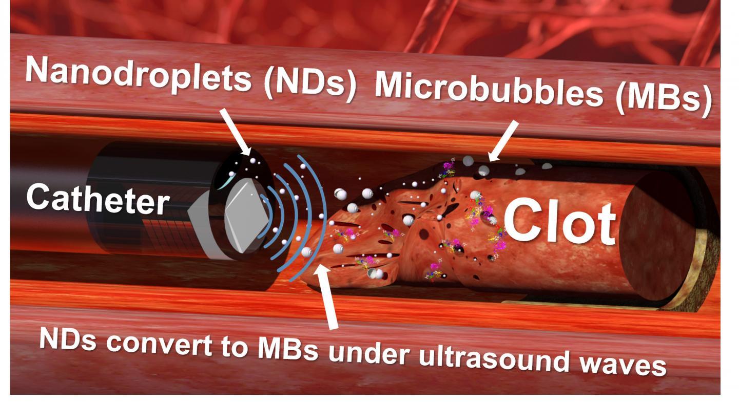 纳米液滴和超声波钻头被证明可有效解决顽固的血凝块