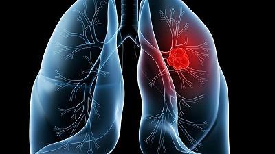 较新的肺癌筛查挽救了更多生命