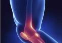 简单的膝盖注射有可能阻止骨关节炎的发作