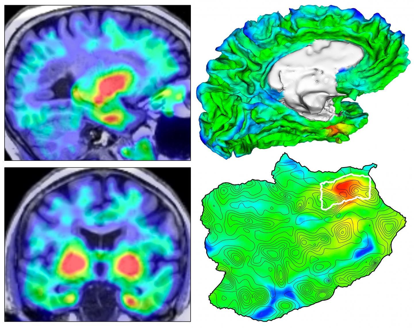 自动成像揭示了TAU蛋白起源于阿尔茨海默氏病脑中的位置