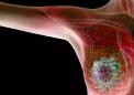 研究更新了无家族史女性的乳腺癌风险评估