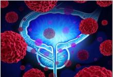研究发现较短的放疗方案对晚期前列腺癌男性安全