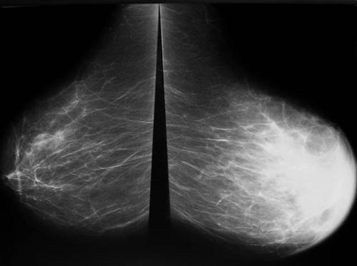 基于蛋白质组学的技术可以帮助验证乳房X光检查