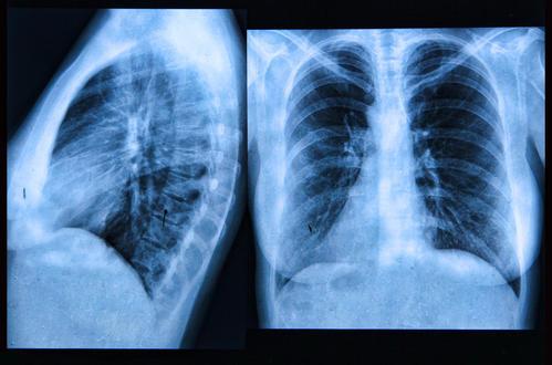 热成像技术无法替代乳房X光照片