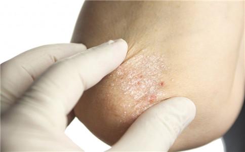 耶鲁大学的研究人员开发出注射剂来治疗皮肤癌