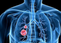 新辅助联合免疫疗法可改善早期非小细胞肺癌的预后