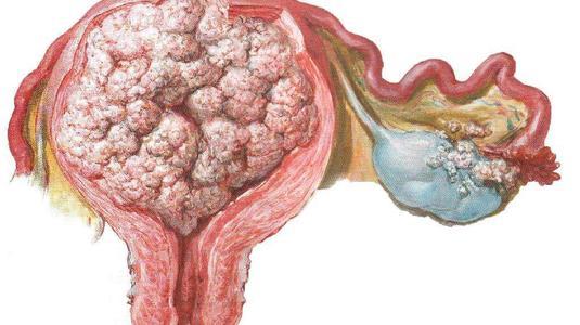 研究显示预防和治疗子宫内膜癌复发的新治疗途径
