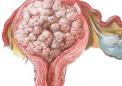 研究显示预防和治疗子宫内膜癌复发的新治疗途径