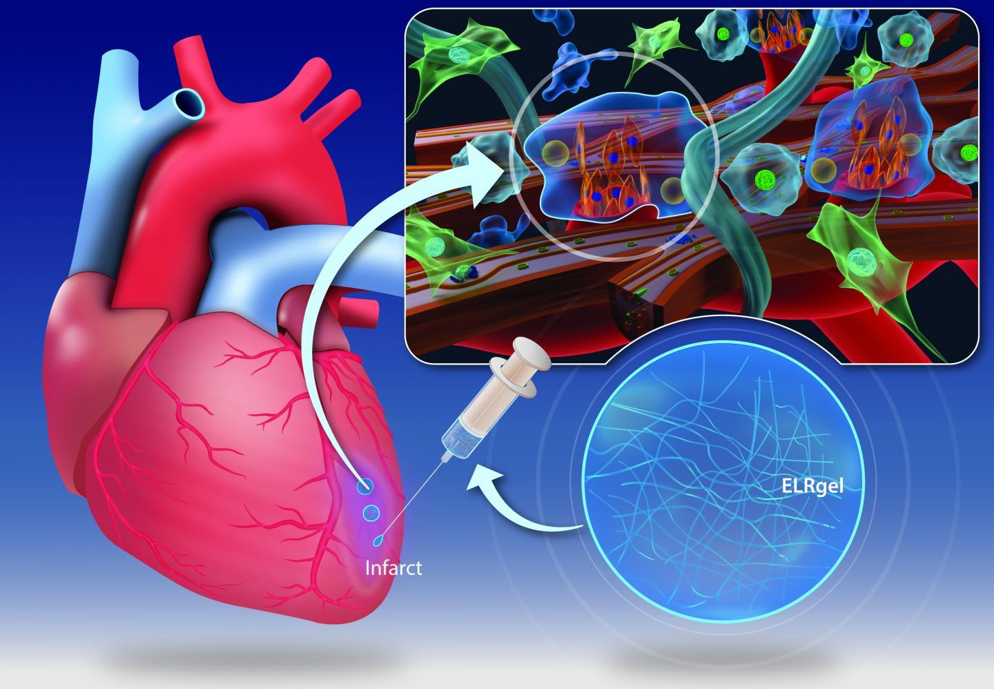水凝胶注射可能会改变心脏病发作后心肌的愈合方式