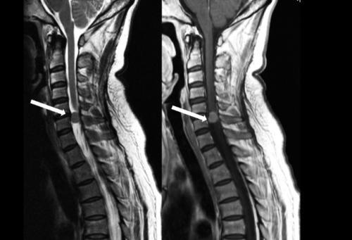 IU研究人员发现脊髓损伤后功能恢复的新潜力