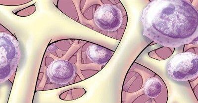 BU研究人员确定了两种可延缓骨髓癌发展的药物