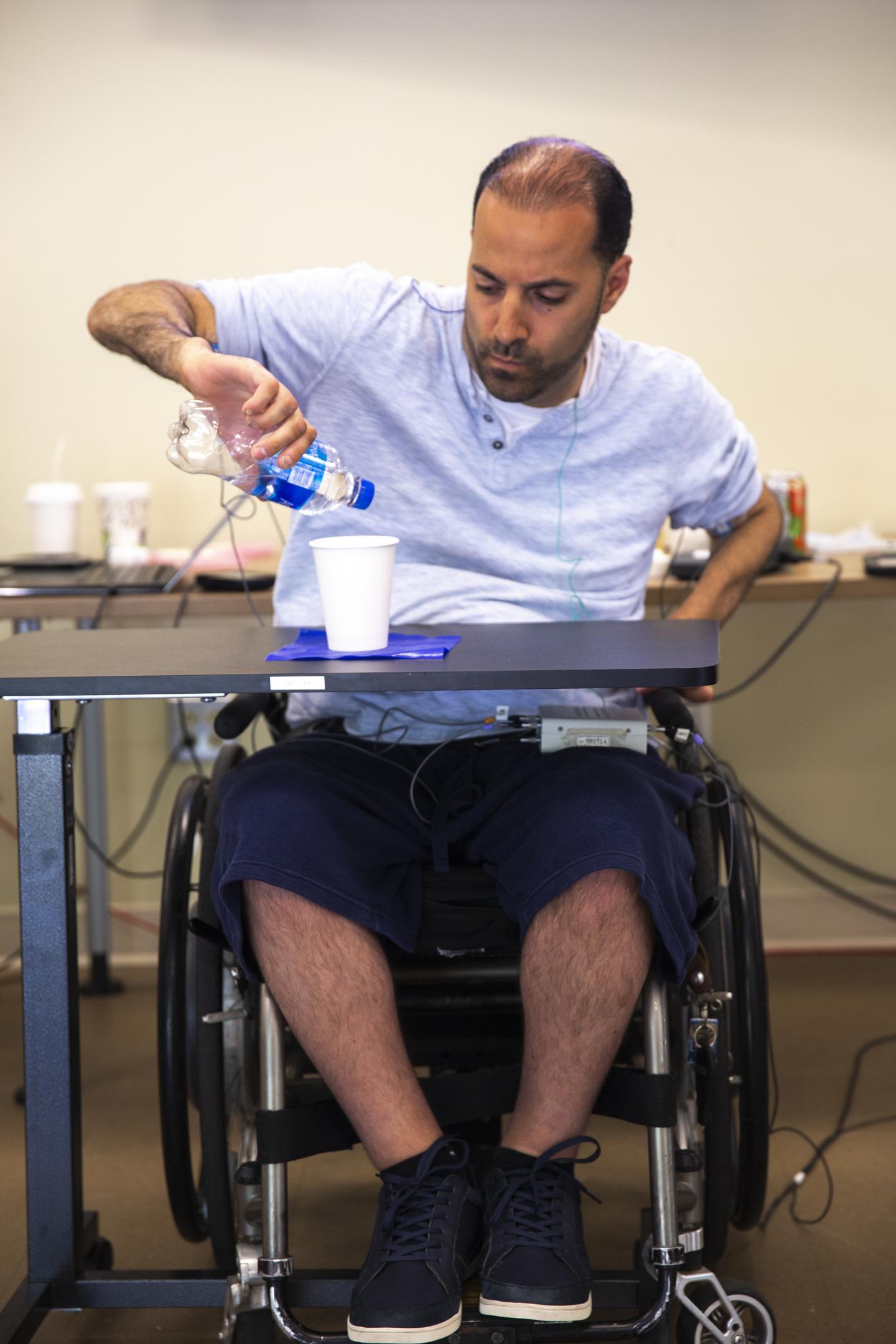 经皮刺激可改善四肢瘫痪患者的手部功能