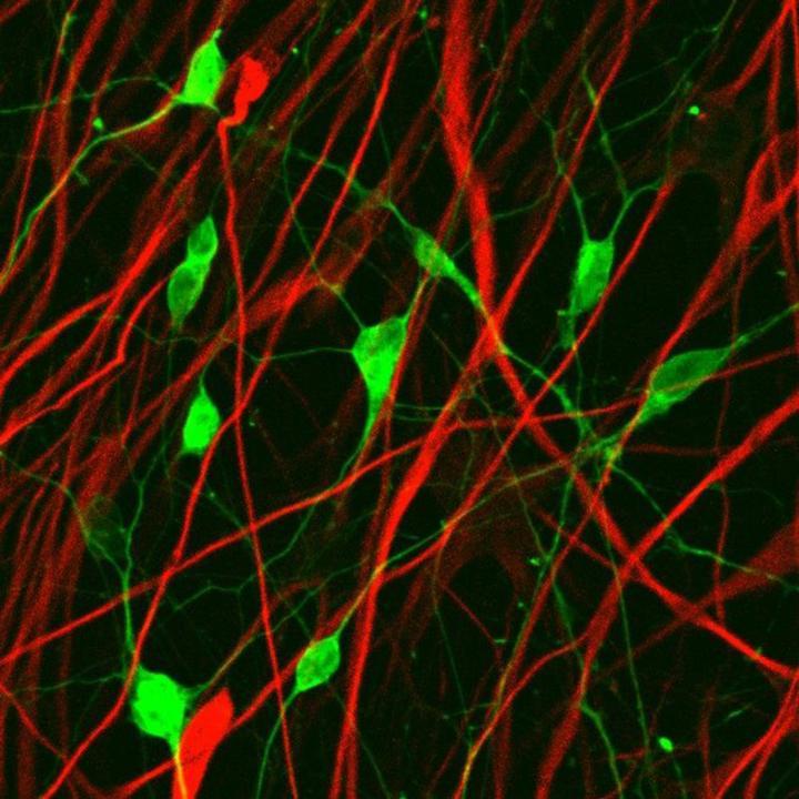 新的抗癌疗法：将神经胶质瘤细胞转化为神经元