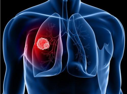 研究人员降低USPSTF肺癌筛查指南中的少数族裔差异的风险预测